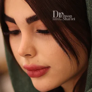 نمونه نتیجه نهایی جراحی بینی طبیعی