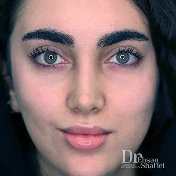 تفاوت بینی طبیعی و بینی استخوانی