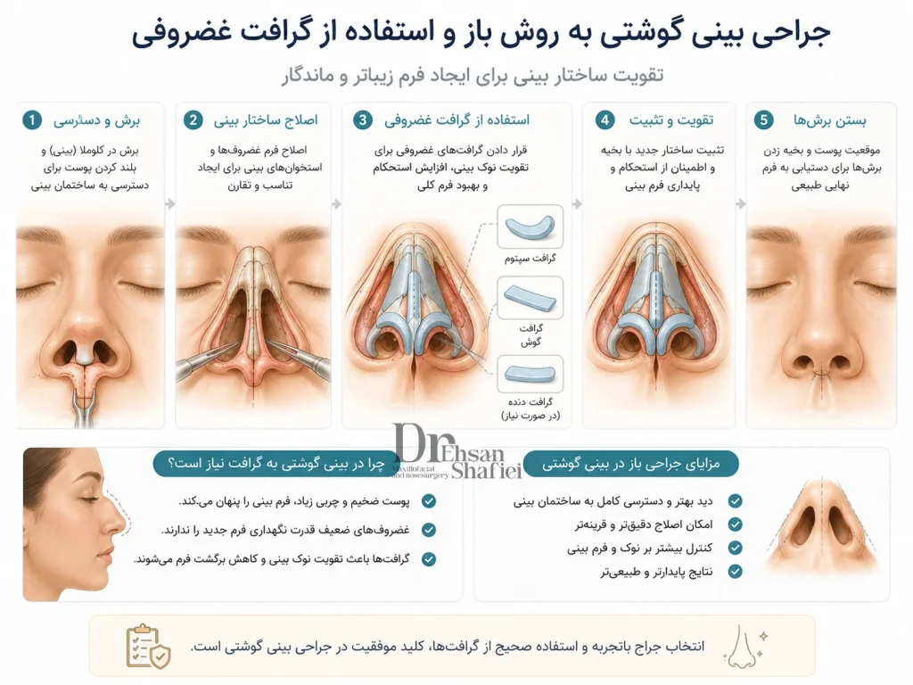 تکنیک جراحی باز و پیوند غضروف در عمل بینی گوشتی