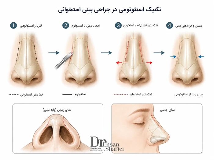 نمایش مفهومی و ساده تکنیک استئوتومی در جراحی بینی استخوانی