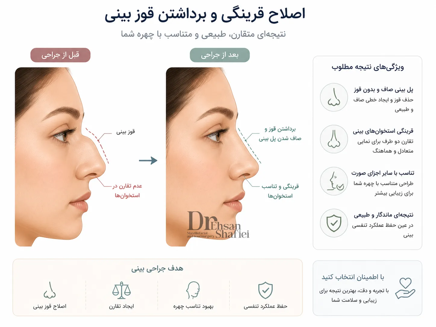 چطور قوز بینی استخوانی بدون کج شدن برداشته میشود؟