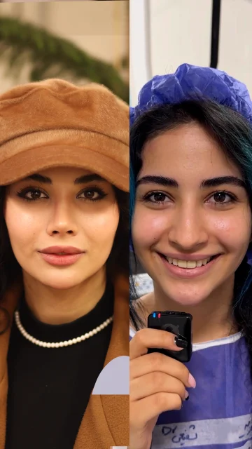 سرخود بودن بعد از عمل بینی