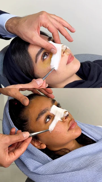 کدام قوس بینی را می‌پسندید
