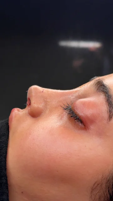 سختی‌های عمل بینی استخوانی