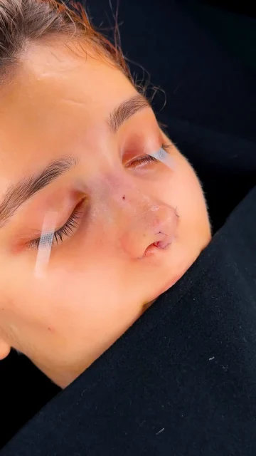 مراجعه از نقاط مختلف ایران و دنیا برای عمل بینی